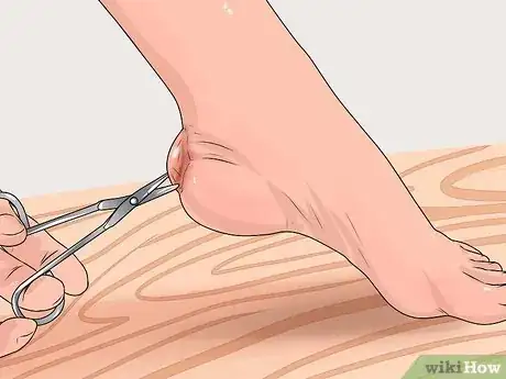 Image titled Care for a Burst Blister Step 10