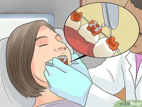 Image titled Prepare on the Day You Get Braces Step 4
