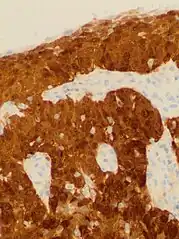 Cervical squamous cell carcinoma generally shows diffuse staining of both nuclei and cytoplasm on p16 immuno-histochemistry (except verrucous variant).